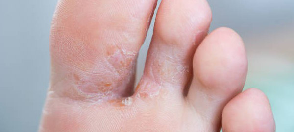 Dermatomicosis o pie de atleta