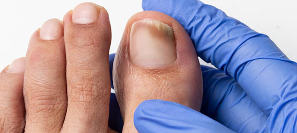 Tratamiento de hongos en las uñas